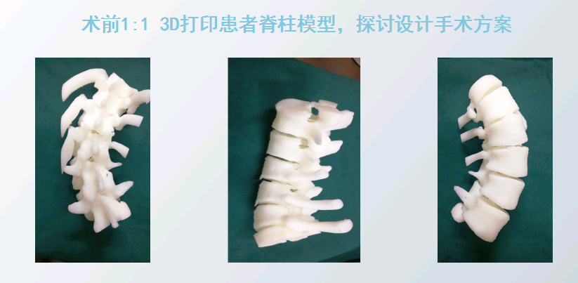 上海數(shù)造攜手安徽省二院骨三科專家章玉冰主任 開展3D打印醫(yī)療骨科應用在線講堂